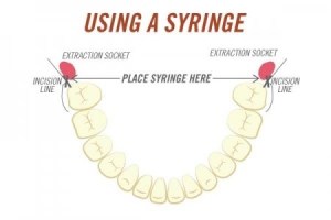 Using a syringe for wisdom teeth extraction