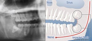 diagram-of-x-ray-and-digital-rendering-of-impacted-teeth